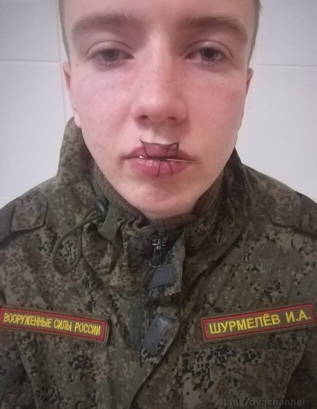 Russia: A 19.year.old soldier was sent for a psychiatric examination after sewing his lips