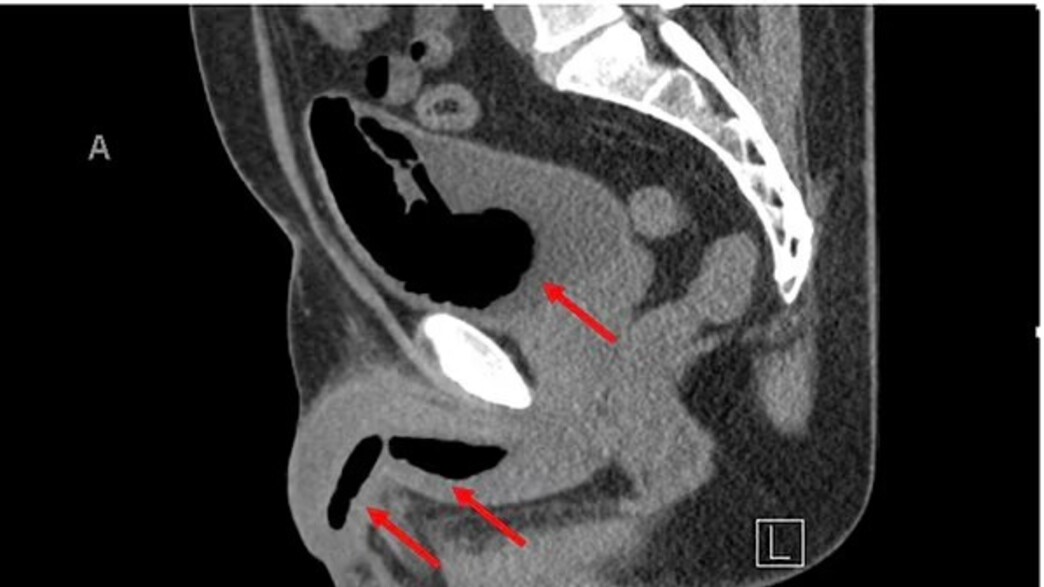 תאונה (צילום: Urology Case Reports)