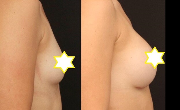 ניתוח הגדלת חזה לפני ואחרי (צילום: באדיבות מרפאתו של ד"ר אברי רווה)