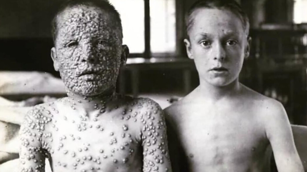 אבעבועות שחורות