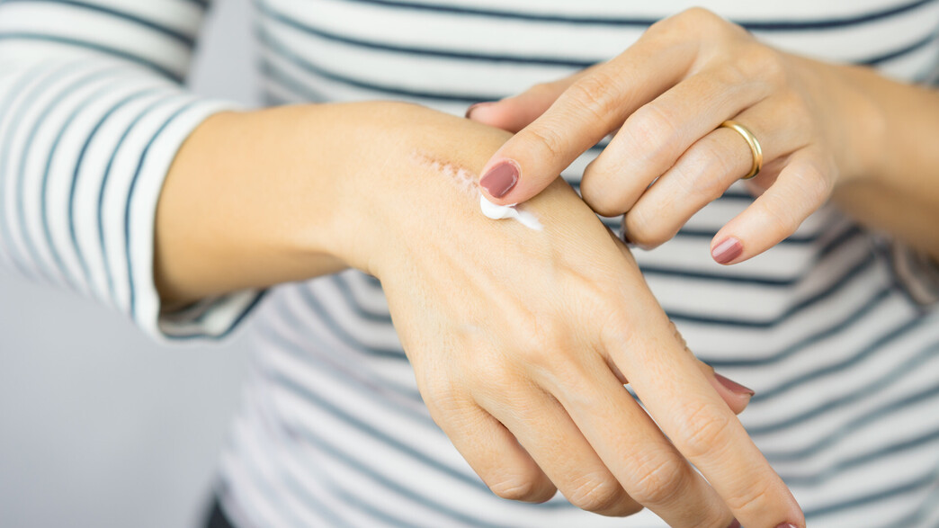 אישה מורחת קרם על צלקת