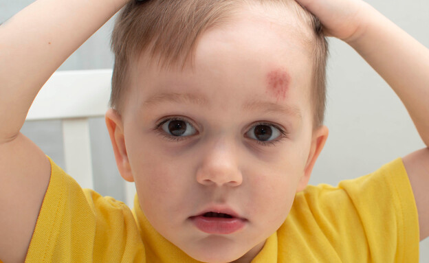 ילד פצוע (צילום: shutterstock Inna_Kandybka)