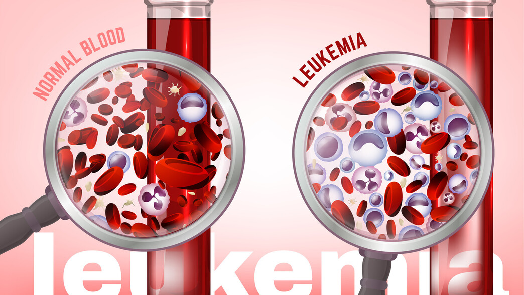 לוקמיה לוקמיה