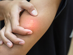 עקיצת דבורה, עקיצת יתוש, עקיצה (צילום: WIRACHAIPHOTO, shutterstock)