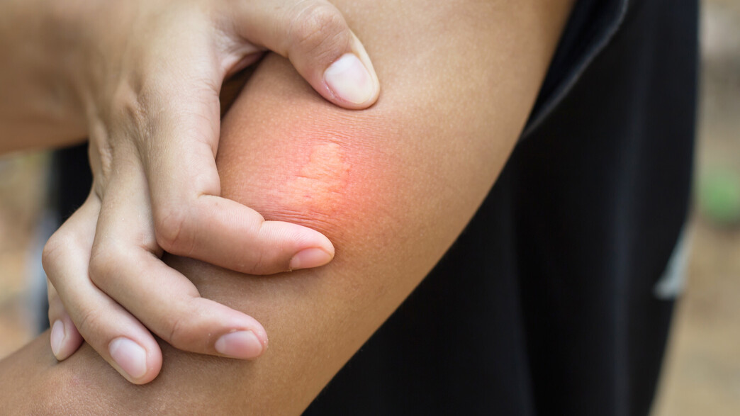 עקיצת דבורה, עקיצת יתוש, עקיצה