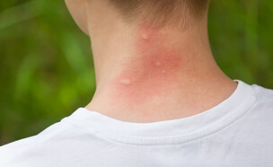 עקיצות, יתוש (צילום: Shutterstock - dimid_86)
