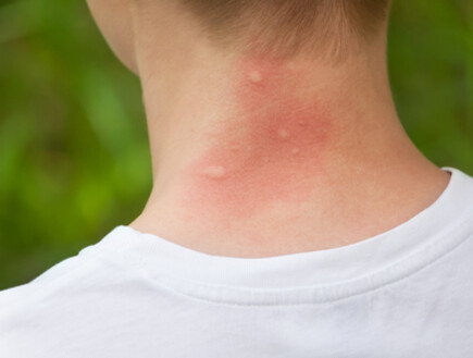 עקיצות, יתוש (צילום: Shutterstock - dimid_86)