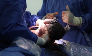 ניתוח נדיר ברמב"ם (צילום: הקריה הרפואית רמב"ם)
