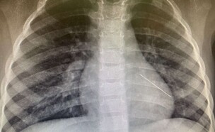 ניתוח ריאה לפעוטה בת 3 (צילום: המרכז הרפואי שניידר)