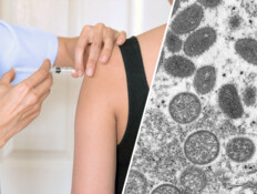 חיסון לאבעבועות הקוף