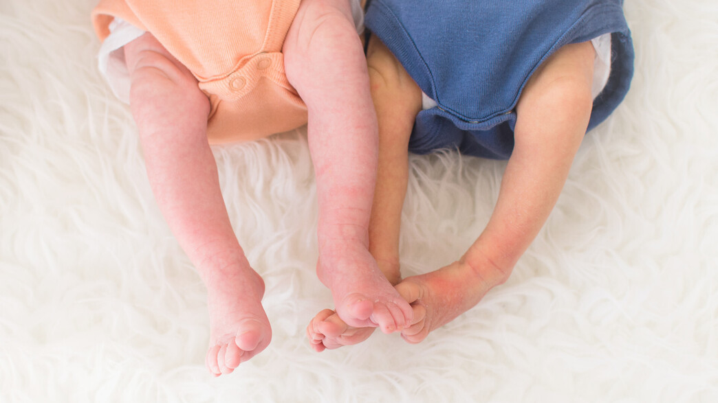 תינוקות עם צהבת תינוקות עם צהבת