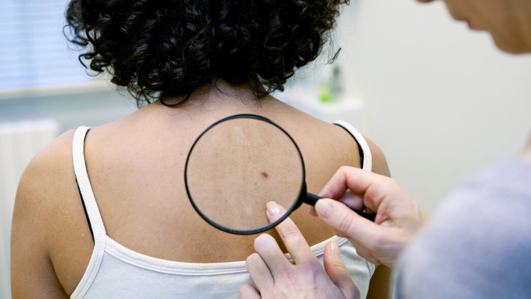 סרטן העור (צילום: Image Point Fr, Shutterstock)