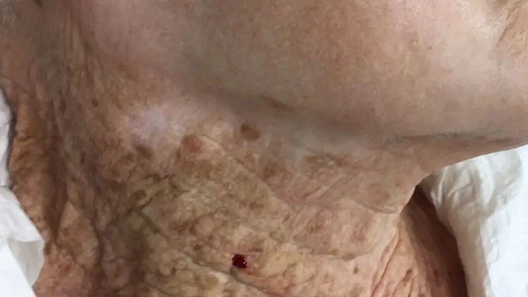 עור בת 92 עור בת 92