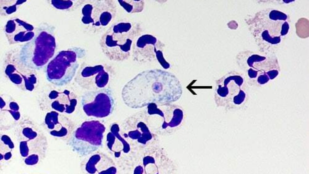 אמבה אוכלת מוח