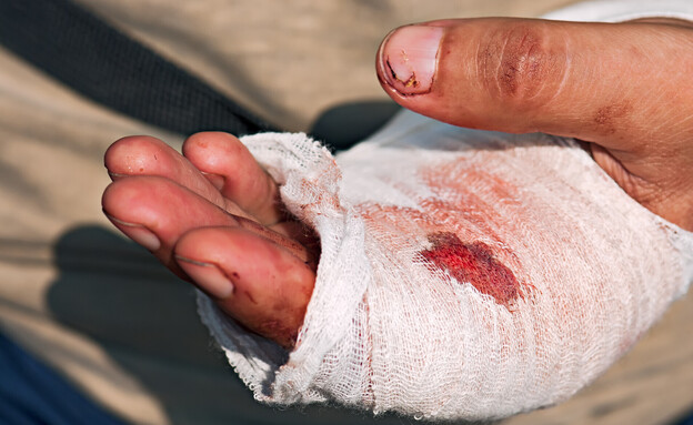 יד פצועה (צילום: Perfect Lazybones, shutterstock)