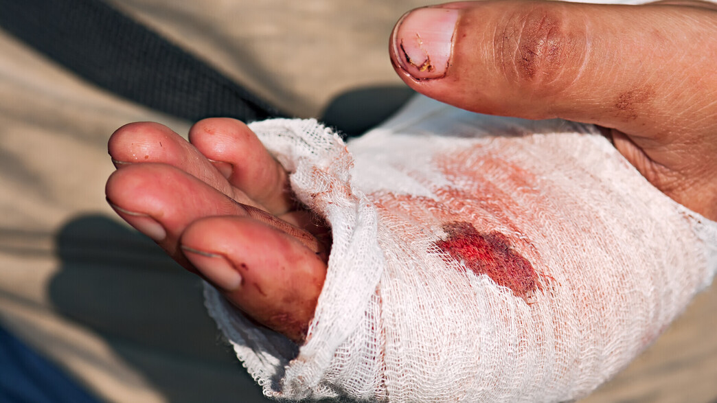 יד פצועה יד פצועה