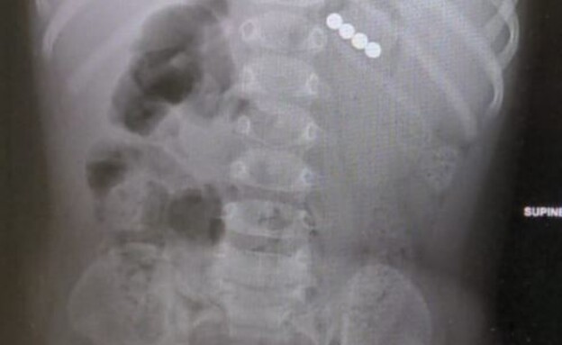 צילום הרנטגן שמראה את המגנטים שנבלעו (צילום: אסותא אשדוד)