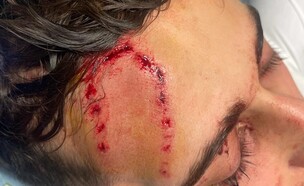 הקב"ט שהותקף באורכידיאה ת"א (צילום: פרטי)