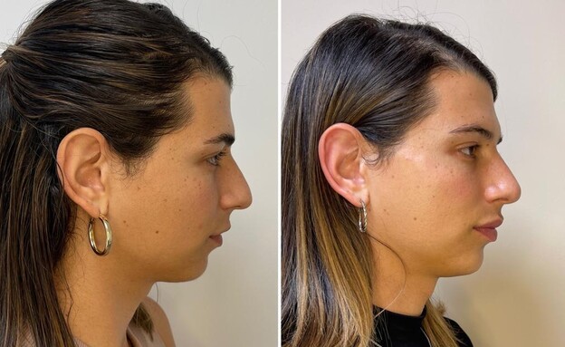 ספיר ברמן, לפני ואחרי הליך נישוי פנים  (צילום: באדיבות ספיר ברמן וד