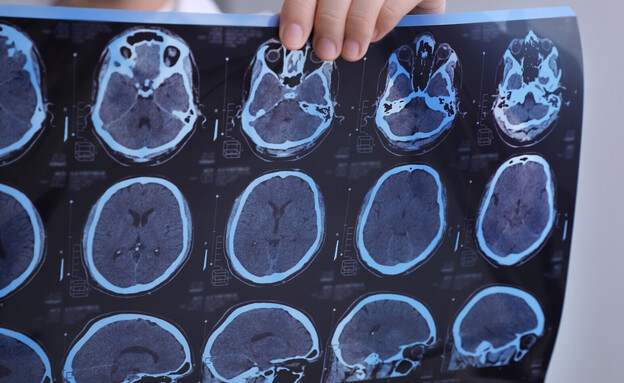 מוח, MRI (צילום: 123RF‏)