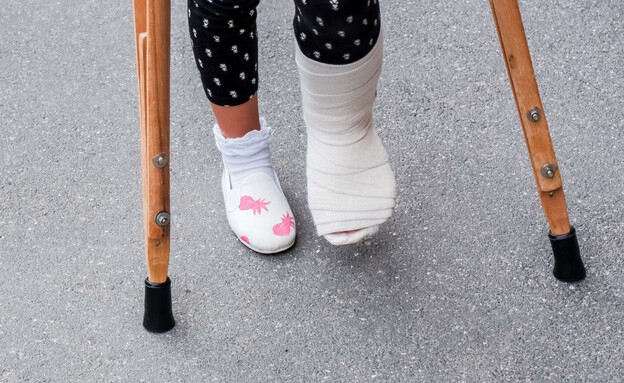 ילדה עם רגל שבורה חבושה בגבס (צילום: 123RF‏)