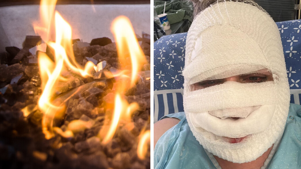 שרון קונפורטי אחרי שנכוותה מקערת אש שרון קונפורטי אחרי שנכוותה מקערת אש