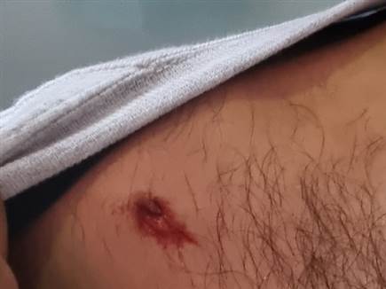 אוהד ירושלים שנפצע מזריקת האבנים