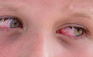 עיניים אדומות (צילום: שאטרסטוק)