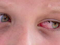 עיניים אדומות (צילום: שאטרסטוק)