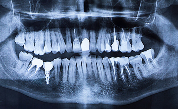 שיניים בטורקיה (צילום: shutterstock)