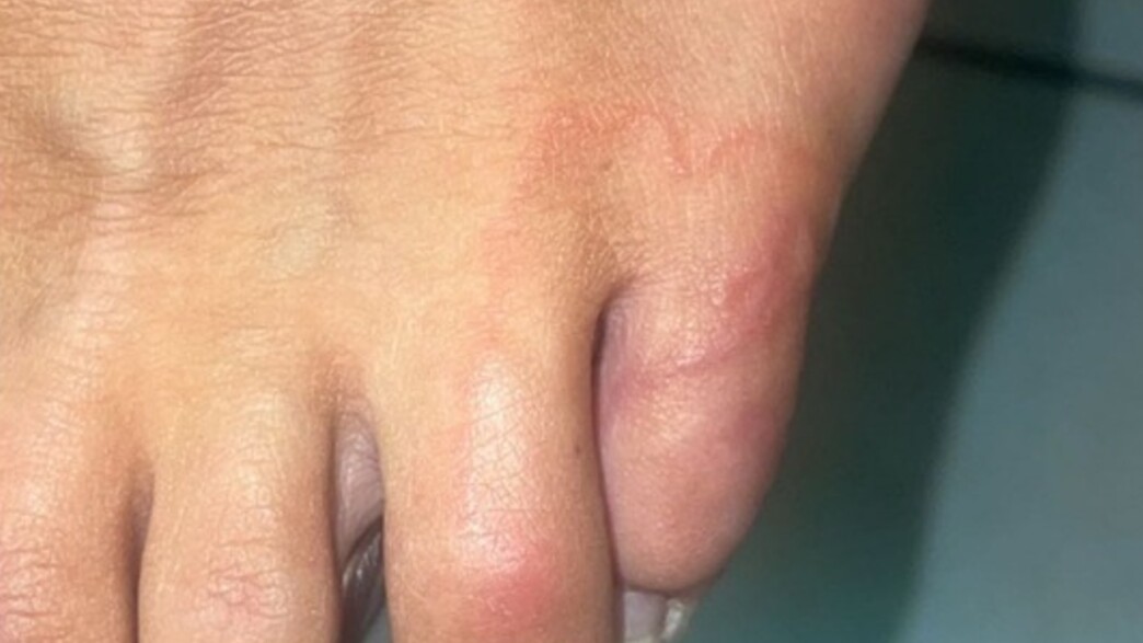 תולעת בתוך העור