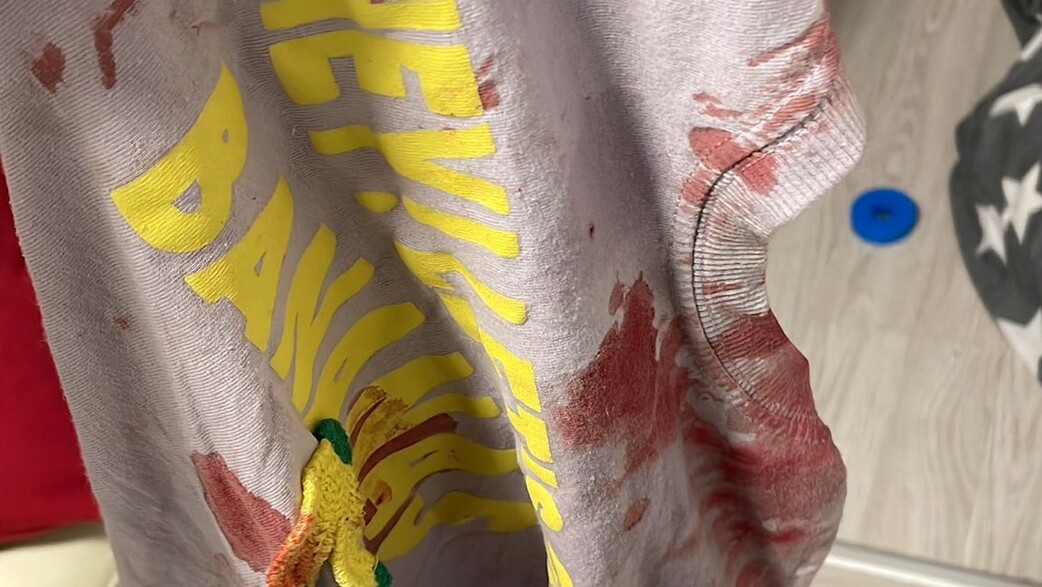 חולצה עם דם לאחר תקיפת ילד מחולדה (צילום: פרטי - מאושר)