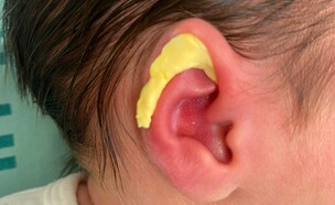 תבנית פלסטית באוזן  (צילום: הקריה הרפואית רמב"ם)