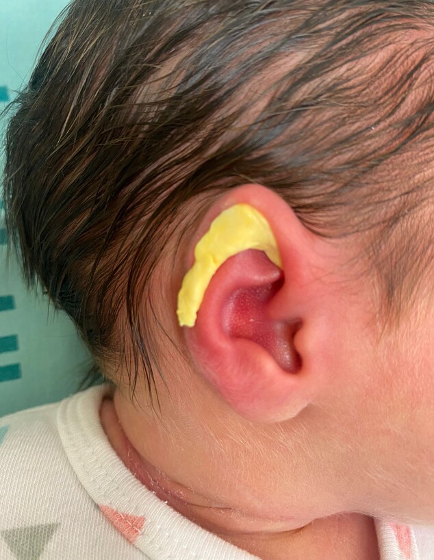 תבנית פלסטית באוזן  (צילום: הקריה הרפואית רמב"ם)