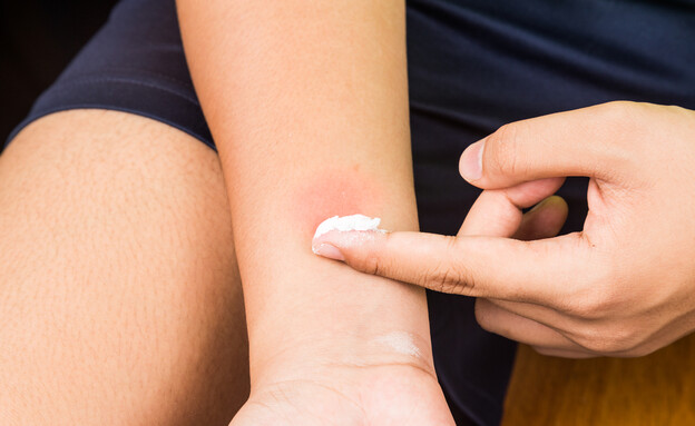 מריחת משחה על עקיצה