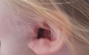 הגירוי באוזן של הילדה מהטיקטוק (צילום: צילום מסך)