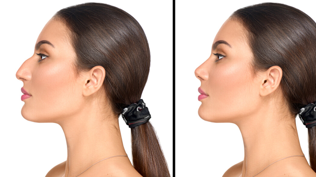 ניתוח אף ניתוח אף