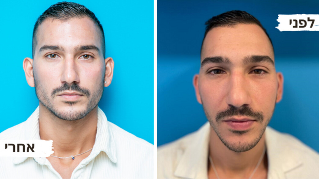 לפני ואחרי: פיסול קו לסת של ד"ר גיל טאובר לפני ואחרי: פיסול קו לסת של ד"ר גיל טאובר