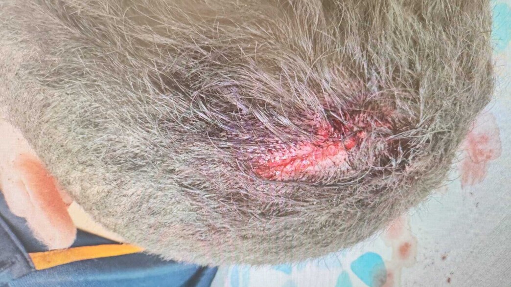 פקח המטרונית הפצוע לאחר התקיפה בקרש פקח המטרונית הפצוע לאחר התקיפה בקרש