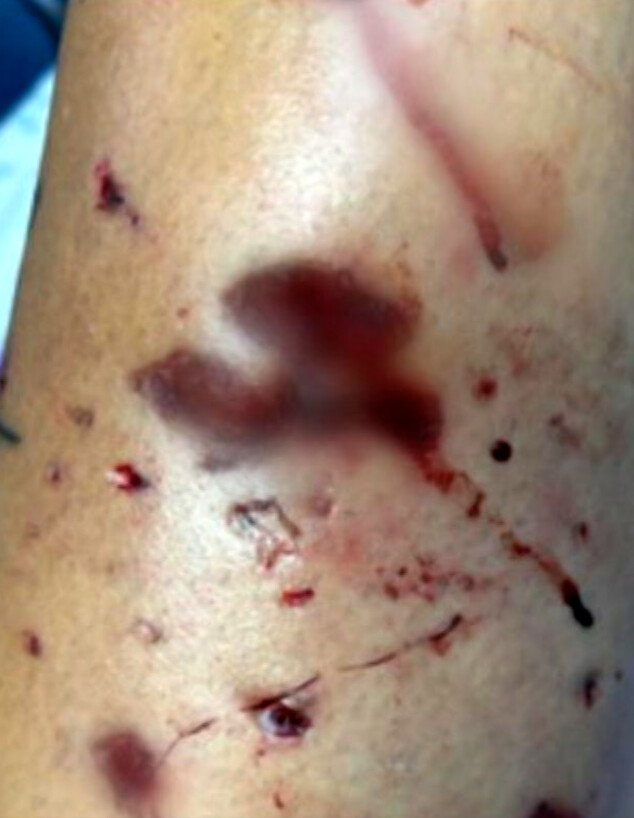 תושבת נתניה שהותקפה באכזריות על ידי כלב (צילום: מתוך "חדשות הבוקר" , קשת 12)