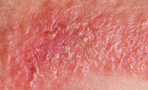 עור מגורה, תגובה אלרגית, אלרגיה לצמחים (צילום: APN Photography, SHUTTERSTOCK)