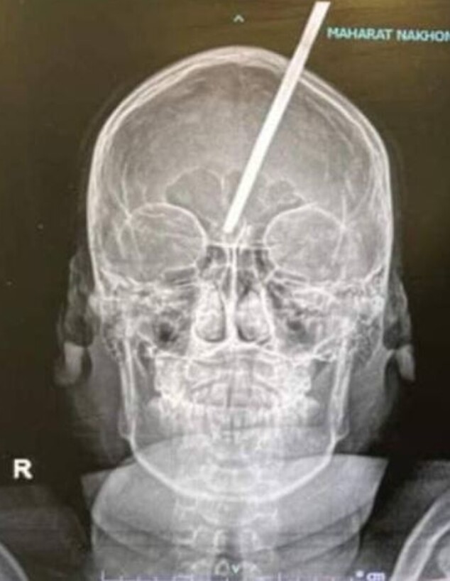 "בטעות": נער "ירה חץ דיג" למוח של חברו – ששרד (צילום: מתוך הרשתות החברתיות לפי סעיף 27א' לחוק זכויות יוצרים)