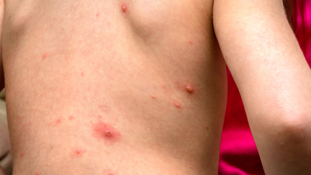 שלבקת חוגרת שלבקת חוגרת