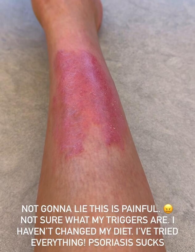 קים מציגה החמרה בפסוריאזיס ממנה סובלת (צילום: instagram)