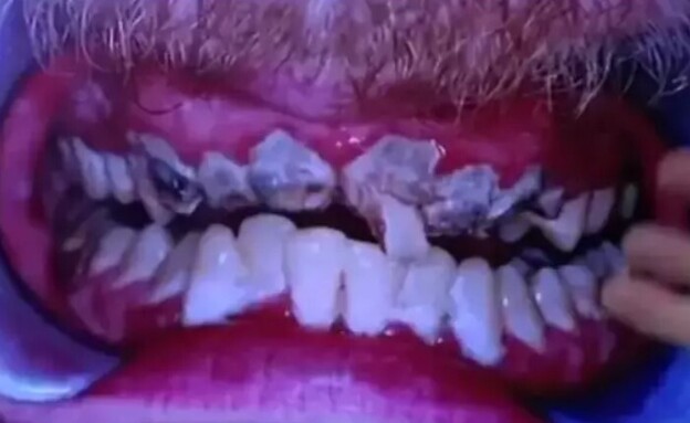 גבר שלא צחצח את השיניים שלו 20 שנה חושף איך הן נראות (צילום: מתוך הרשתות החברתיות לפי סעיף 27א' לחוק זכויות יוצרים)