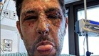 עידן עמדי בתמונה ממחלקת טראומה אחרי הפציעה בלחימה בעזה (צילום: instagram)