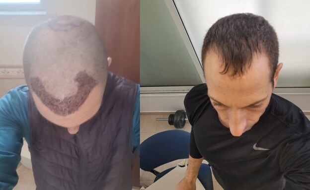 New Locations Chosen by Israelis for Hair Transplants