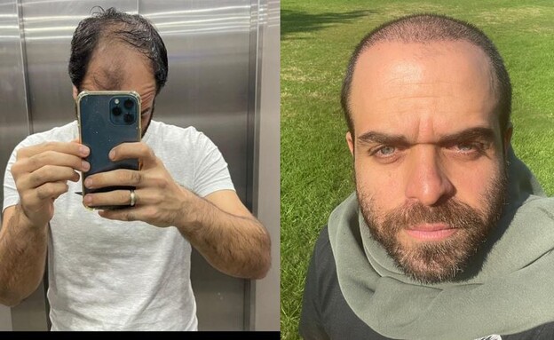 אבי לפני ואחרי (צילום: פרטי)