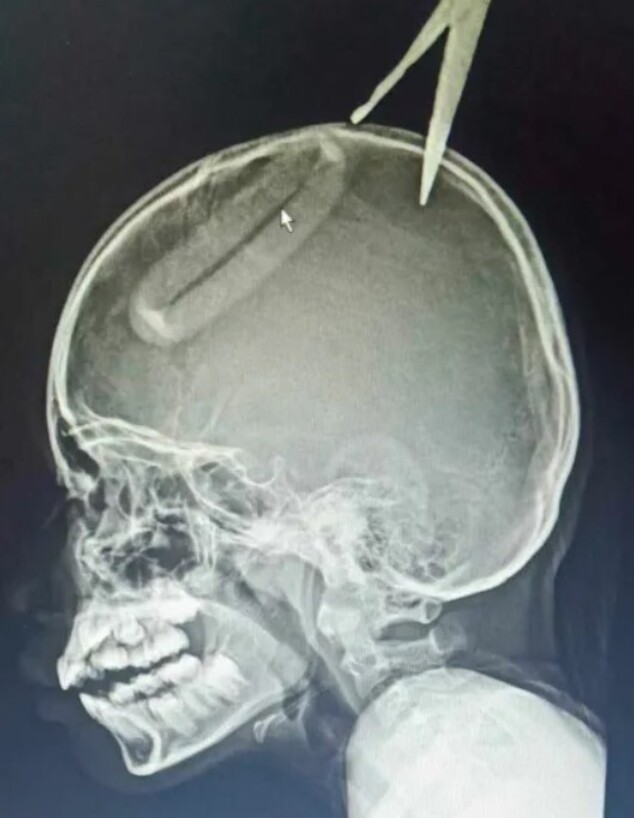 צילום הרנטגן של בת ה-10 שנדקרה ע"י אחיה (צילום: מתוך הרשתות החברתיות לפי סעיף 27א' לחוק זכויות יוצרים)