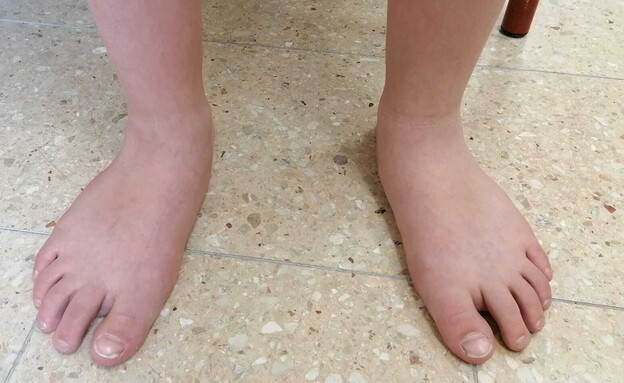 Understanding Flat Feet: A Comprehensive Guide to This Common Condition